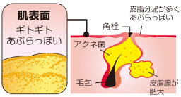 思春期のニキビ 典型例