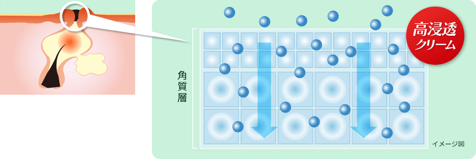 アクネス25の高浸透クリーム