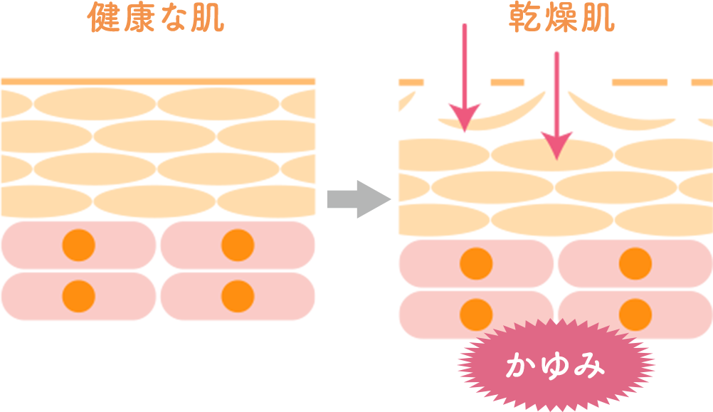 かゆみの起こる原因