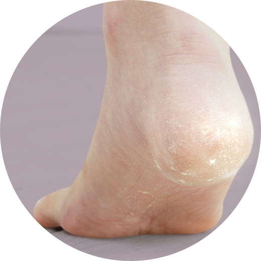 ガサガサかかと