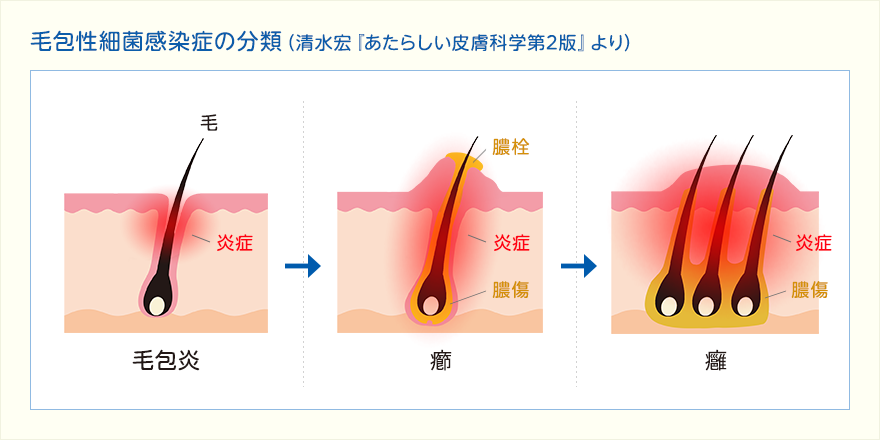 毛包性細菌感染症の分類