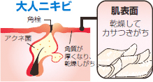 大人ニキビ
