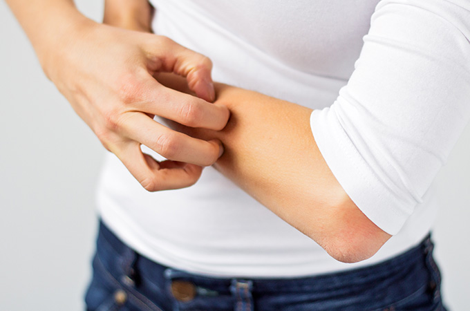 アトピー性皮膚炎の主な原因