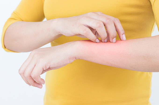 湿疹（皮膚炎）について