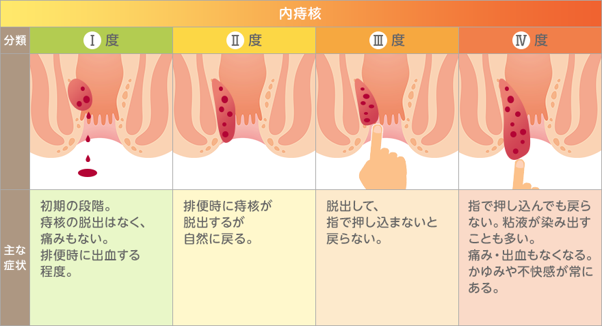 内痔核のグレード
