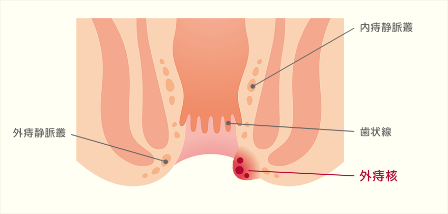 外痔核
