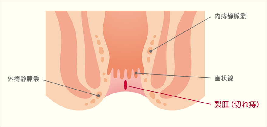 裂肛（切れ痔）