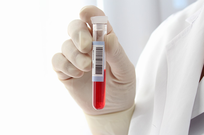 蕁麻疹の検査・対策