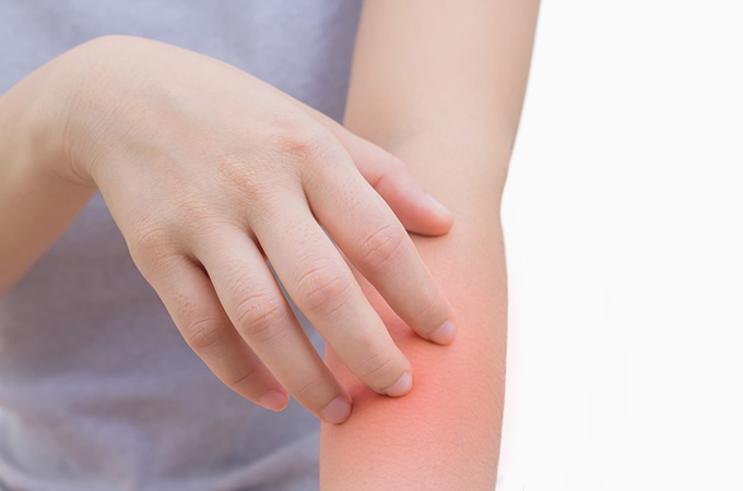 蕁麻疹の仕組み