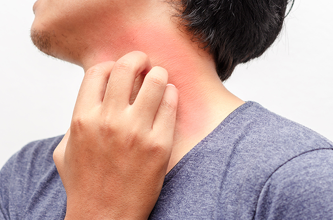 虫刺されの症状