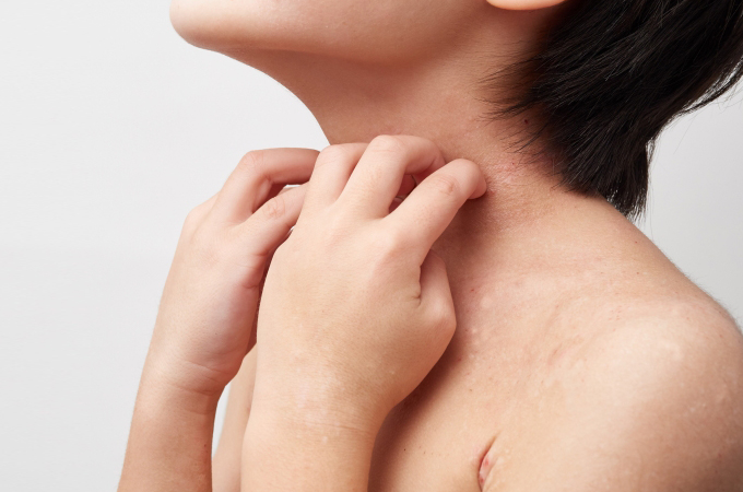 あせも（汗疹）について