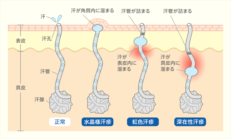 あせも（汗疹）の原因と仕組み