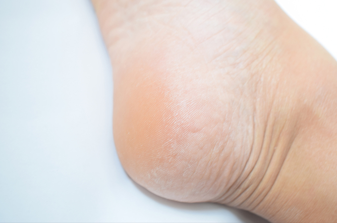 角化症について