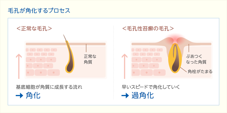 毛孔が角化するプロセス