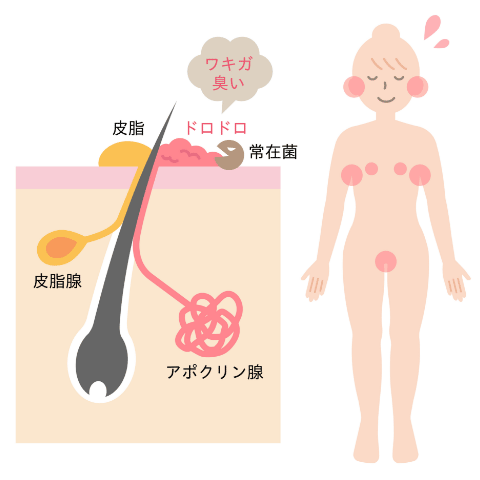 耳垢が湿っている＝ワキガ体質？耳垢とワキガの関係