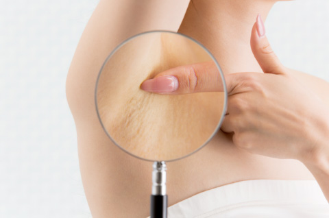 ワキガの対策として脱毛が向いている人のタイプ