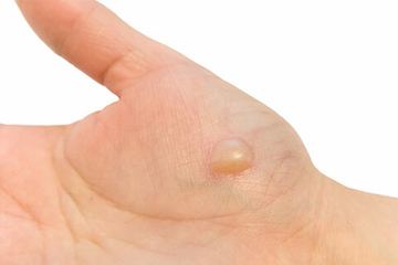 やけどをして“水ぶくれ”ができてしまいました