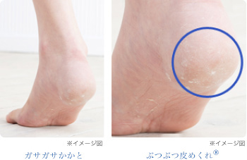 ガサガサかかと・ぶつぶつ皮めくれ&reg;の写真