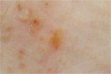 小水疱型の写真