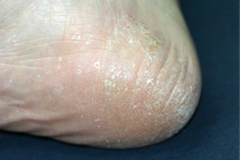 角質増殖型の写真