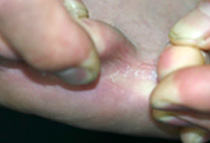 趾間（しかん）型