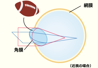 乱視のある角膜