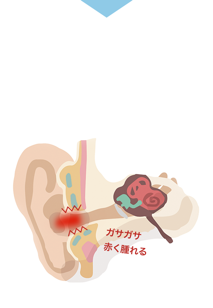 図：くり返す耳のかゆみは、耳の中の皮ふ・耳まわりが炎症を起こしているから。ガサガサ　赤く腫れる