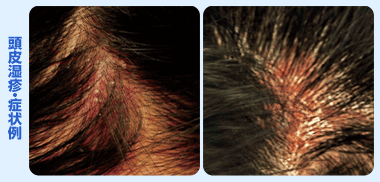 頭皮湿疹・症状例