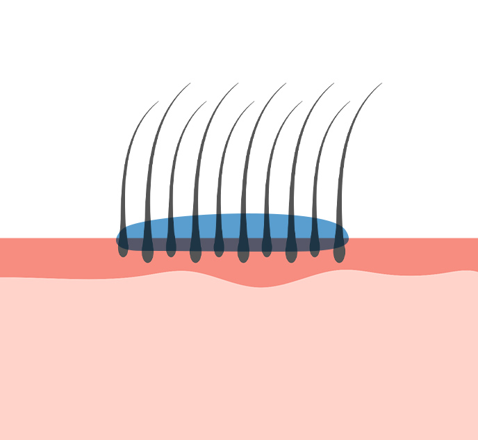 塗布した患部の図