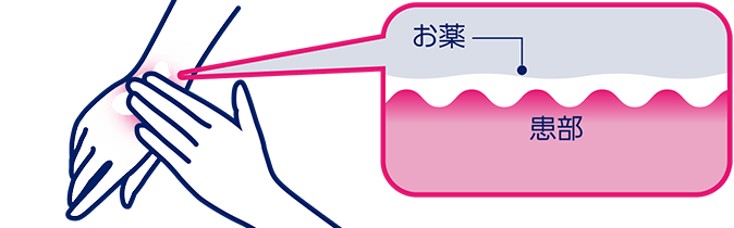 患部全体を覆うように、お薬をやさしくのばしてください。擦りこまず乗せるように塗ると、湿疹部分にきちんとお薬がつきます。