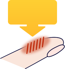 皮ふが治っていく図