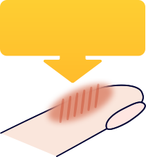 皮ふが治っていく図