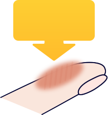 皮ふが治っていく図