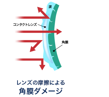 レンズ摩擦による角膜ダメージ