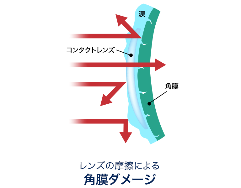 レンズ摩擦による角膜ダメージ
