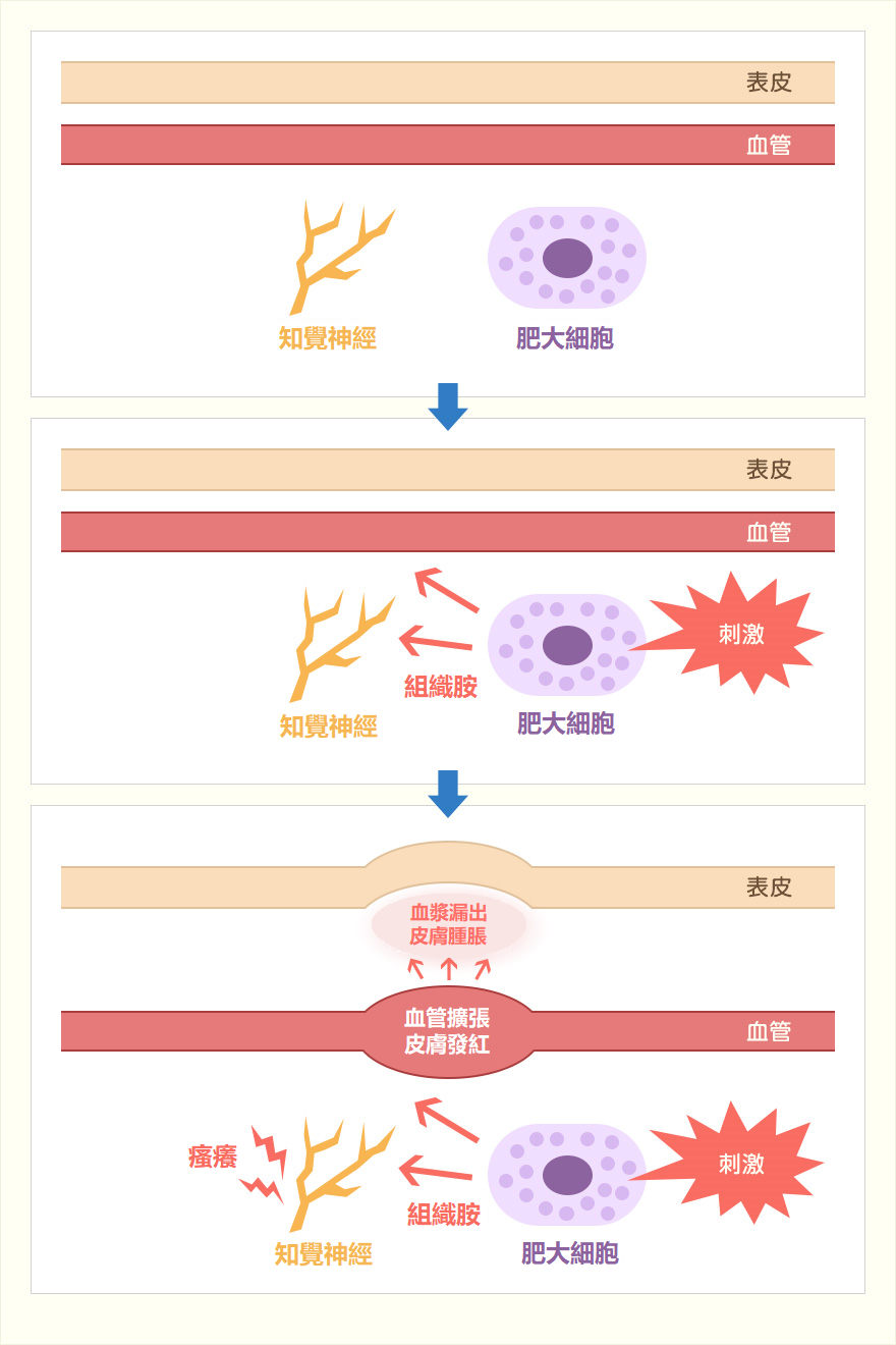 荨麻疹产生机理 肥大细胞 组织胺