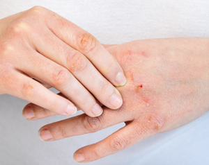 つらいヒビ、あかぎれ、どうにかしたい！冬の正しいハンドケア