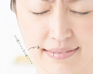 唇のひび割れは、治療薬でしっかりケア