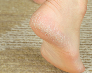 靴下が引っ掛かる！ストッキングが伝線する！冬のガサガサかかとをケアする方法とは？