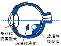 年龄对眼睛的影响
